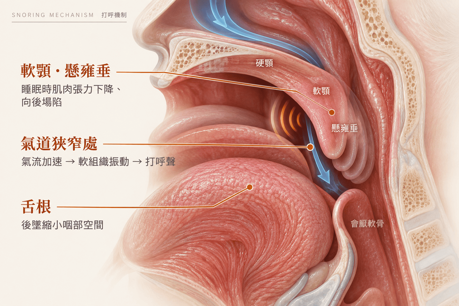 打呼成因示意圖，顯示睡眠時軟顎振動與上呼吸道狹窄，樂樂耳鼻喉科診所