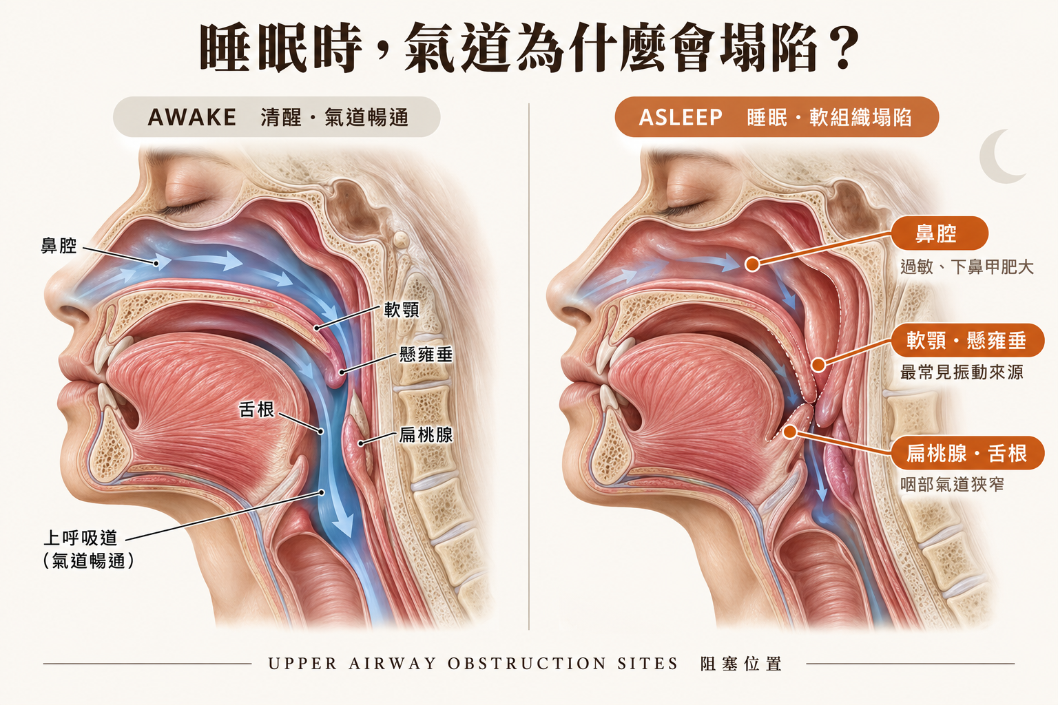 睡眠呼吸中止症上呼吸道阻塞示意圖・樂樂耳鼻喉科診所