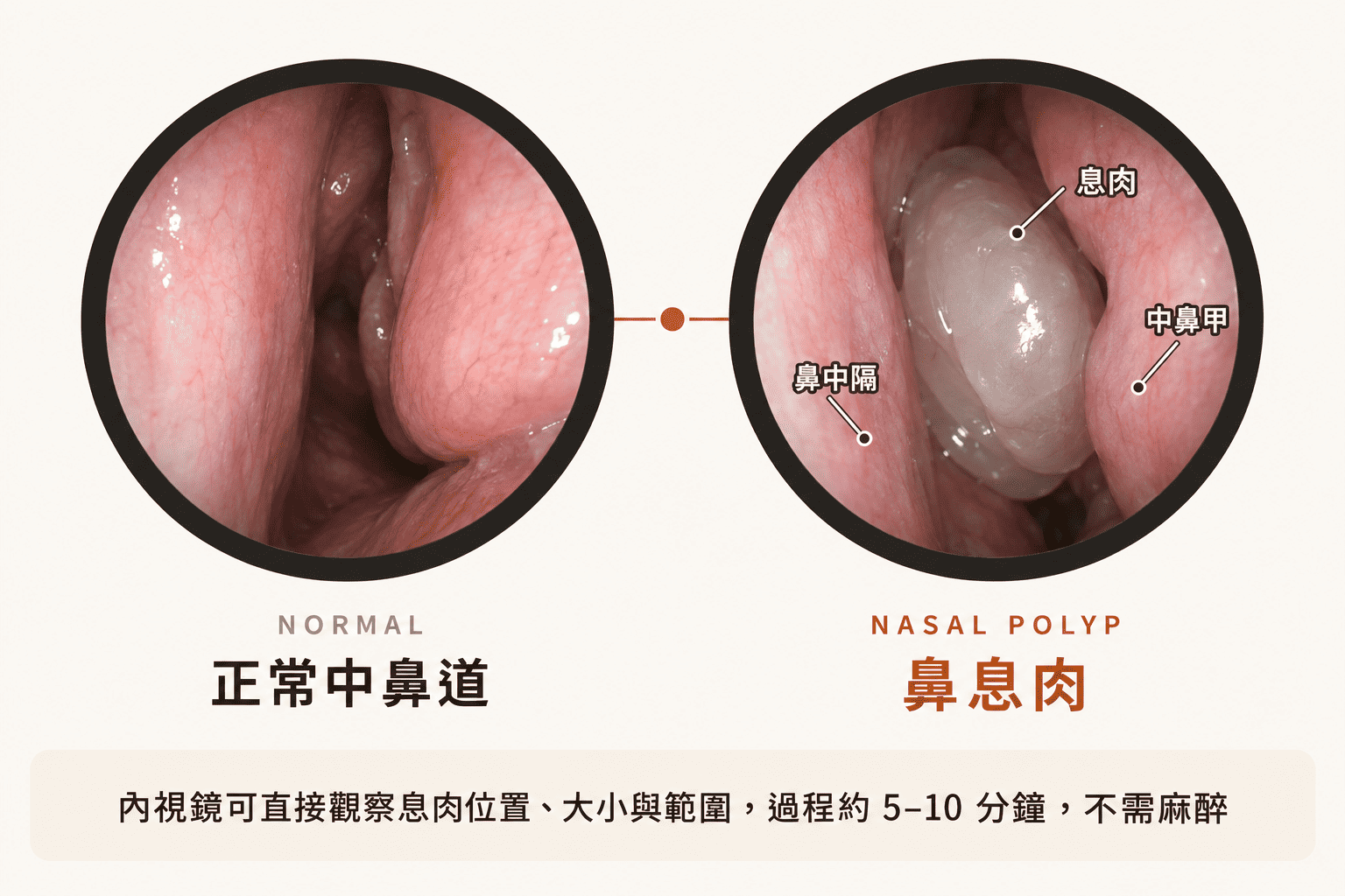 鼻腔內視鏡檢查鼻息肉畫面，顯示中鼻道息肉位置－樂樂耳鼻喉科診所