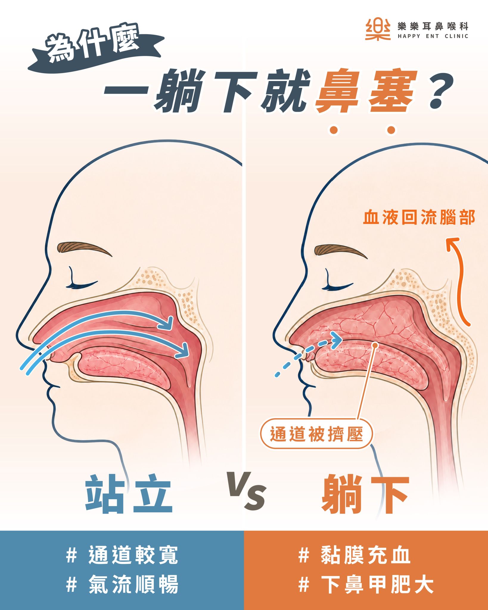 鼻塞用藥與處理方向