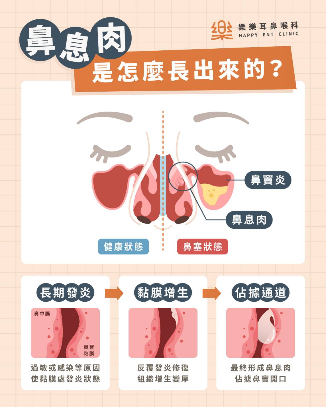 鼻息肉外觀與位置示意